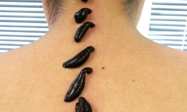 Герудотерапія у Жмеринській лікарні відновного лікування